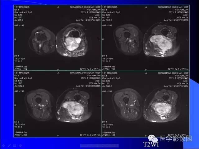 【病例】大腿恶性孤立性纤维瘤1例MR影像表现 【病例】大腿恶性孤立性纤维瘤1例MR影像表现
