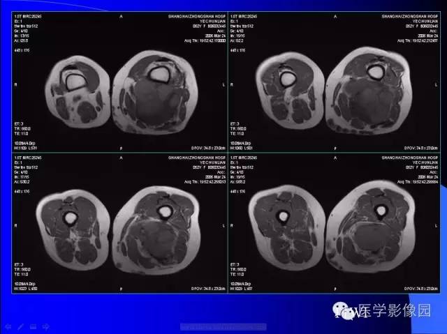 【病例】大腿恶性孤立性纤维瘤1例MR影像表现 【病例】大腿恶性孤立性纤维瘤1例MR影像表现
