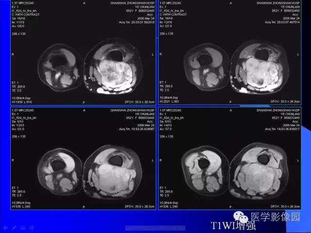 【病例】大腿恶性孤立性纤维瘤1例MR影像表现 【病例】大腿恶性孤立性纤维瘤1例MR影像表现