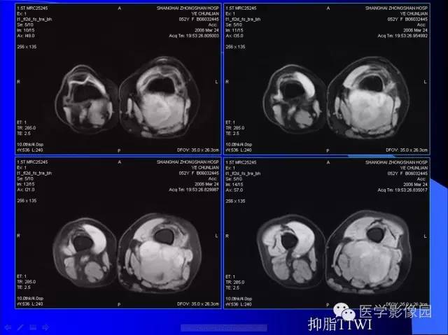【病例】大腿恶性孤立性纤维瘤1例MR影像表现 【病例】大腿恶性孤立性纤维瘤1例MR影像表现