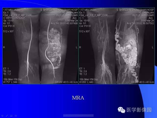 【病例】大腿恶性孤立性纤维瘤1例MR影像表现 【病例】大腿恶性孤立性纤维瘤1例MR影像表现