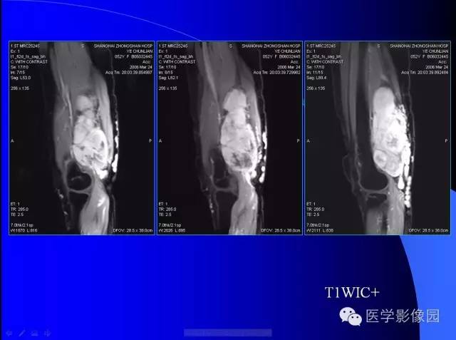 【病例】大腿恶性孤立性纤维瘤1例MR影像表现 【病例】大腿恶性孤立性纤维瘤1例MR影像表现