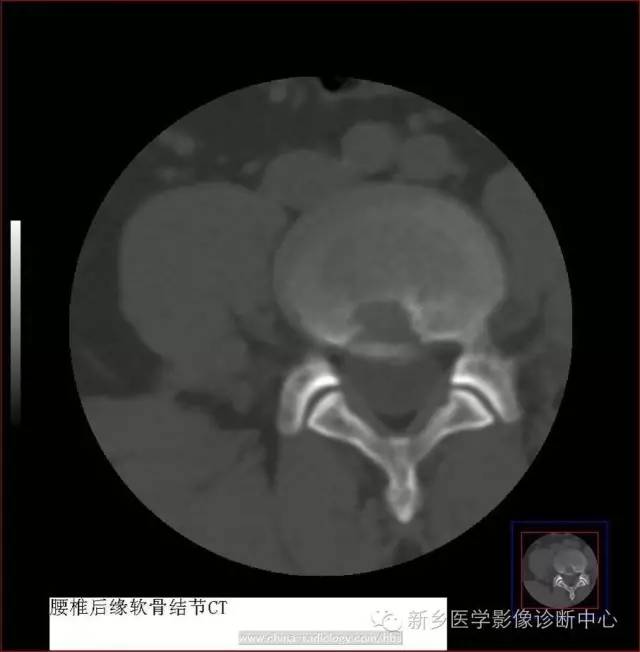 椎缘骨/软骨结节，一个偶尔会遇到的疾病
