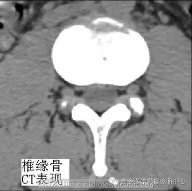 椎缘骨/软骨结节，一个偶尔会遇到的疾病