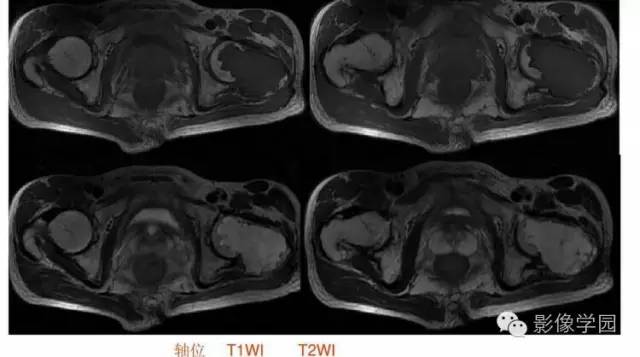 【病例】股骨软骨粘液样纤维瘤1例X线及MR影像表现