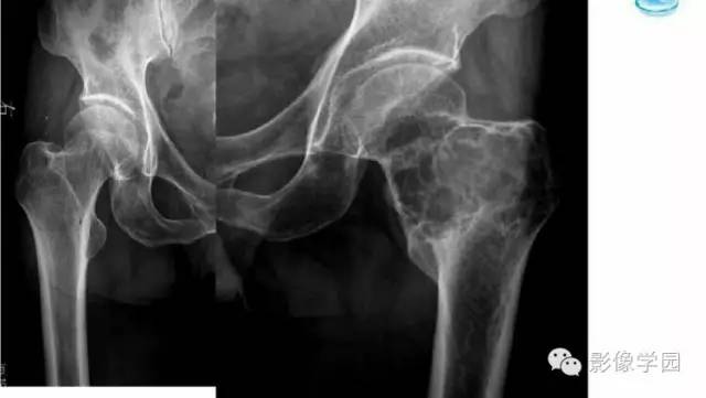 【病例】股骨软骨粘液样纤维瘤1例X线及MR影像表现