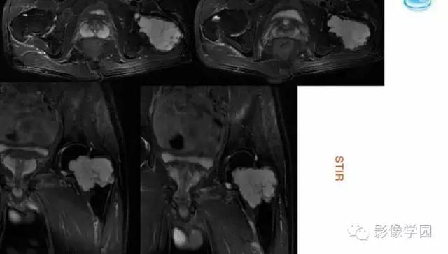 【病例】股骨软骨粘液样纤维瘤1例X线及MR影像表现