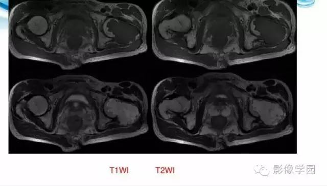 【病例】股骨软骨粘液样纤维瘤1例X线及MR影像表现