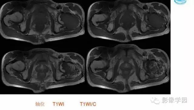 【病例】股骨软骨粘液样纤维瘤1例X线及MR影像表现