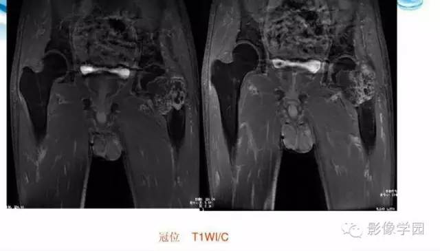 【病例】股骨软骨粘液样纤维瘤1例X线及MR影像表现
