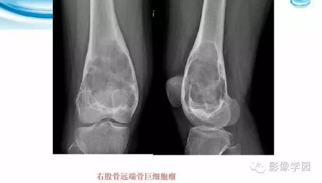 【病例】股骨软骨粘液样纤维瘤1例X线及MR影像表现