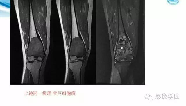【病例】股骨软骨粘液样纤维瘤1例X线及MR影像表现