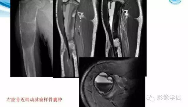 【病例】股骨软骨粘液样纤维瘤1例X线及MR影像表现