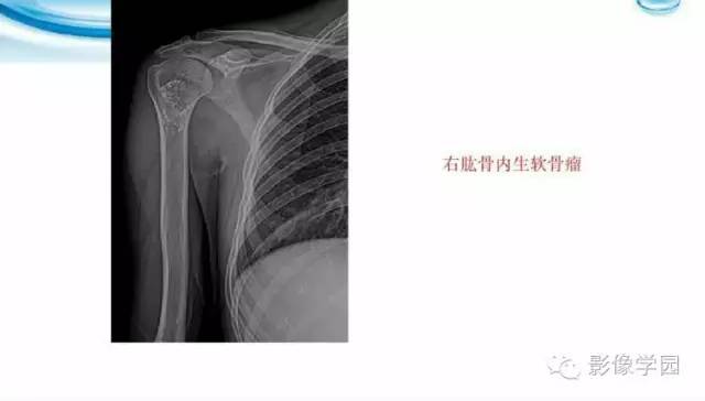 【病例】股骨软骨粘液样纤维瘤1例X线及MR影像表现