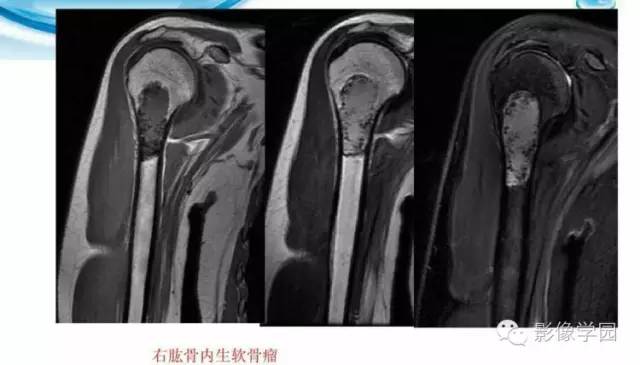 【病例】股骨软骨粘液样纤维瘤1例X线及MR影像表现