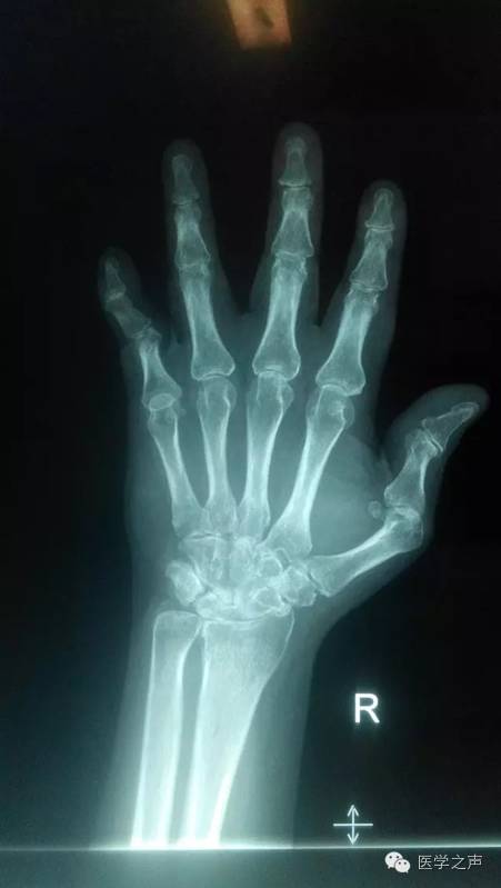 【病例】双手类风湿性关节炎1例X线影像表现