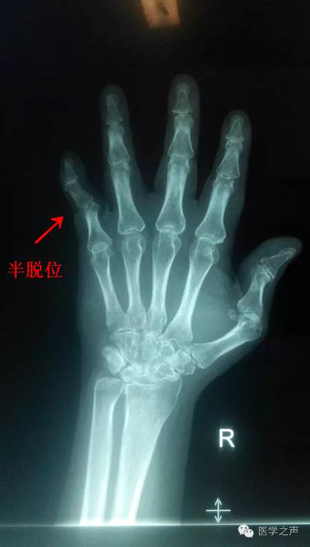 【病例】双手类风湿性关节炎1例X线影像表现