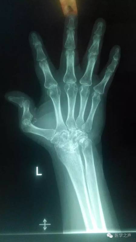 【病例】双手类风湿性关节炎1例X线影像表现