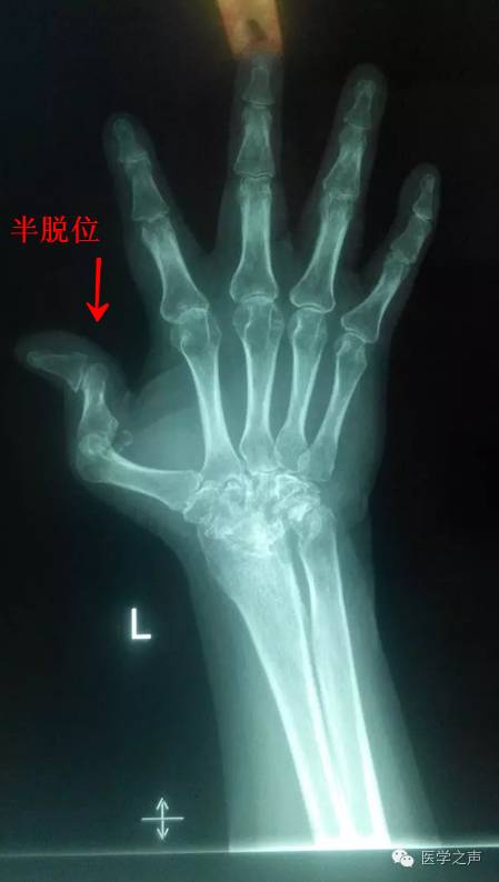 【病例】双手类风湿性关节炎1例X线影像表现