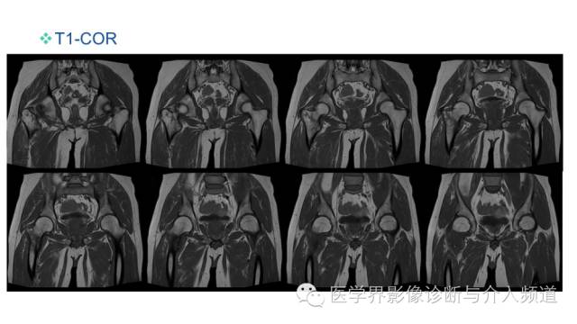 【病例】骨样骨瘤1例MR影像表现 【病例】骨样骨瘤1例MR影像表现