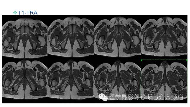 【病例】骨样骨瘤1例MR影像表现 【病例】骨样骨瘤1例MR影像表现