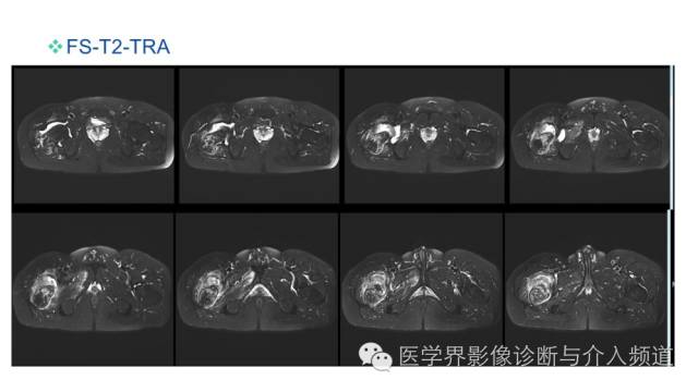 【病例】骨样骨瘤1例MR影像表现 【病例】骨样骨瘤1例MR影像表现