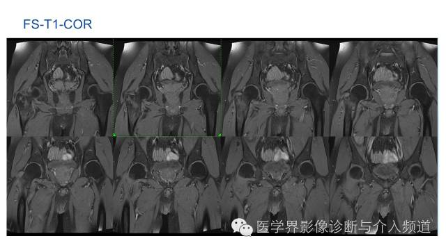 【病例】骨样骨瘤1例MR影像表现 【病例】骨样骨瘤1例MR影像表现