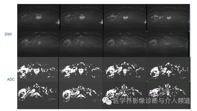 【病例】骨样骨瘤1例MR影像表现 【病例】骨样骨瘤1例MR影像表现