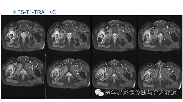 【病例】骨样骨瘤1例MR影像表现 【病例】骨样骨瘤1例MR影像表现
