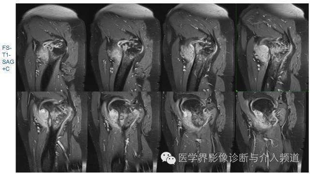【病例】骨样骨瘤1例MR影像表现 【病例】骨样骨瘤1例MR影像表现