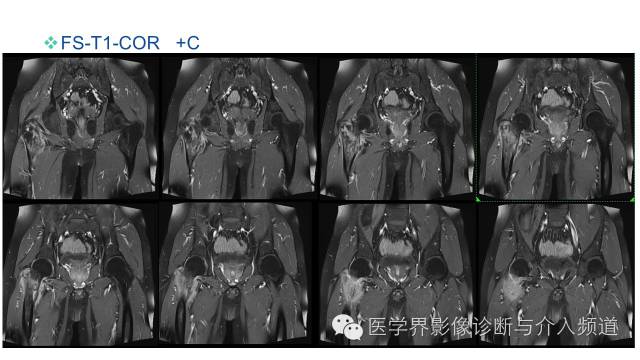 【病例】骨样骨瘤1例MR影像表现 【病例】骨样骨瘤1例MR影像表现