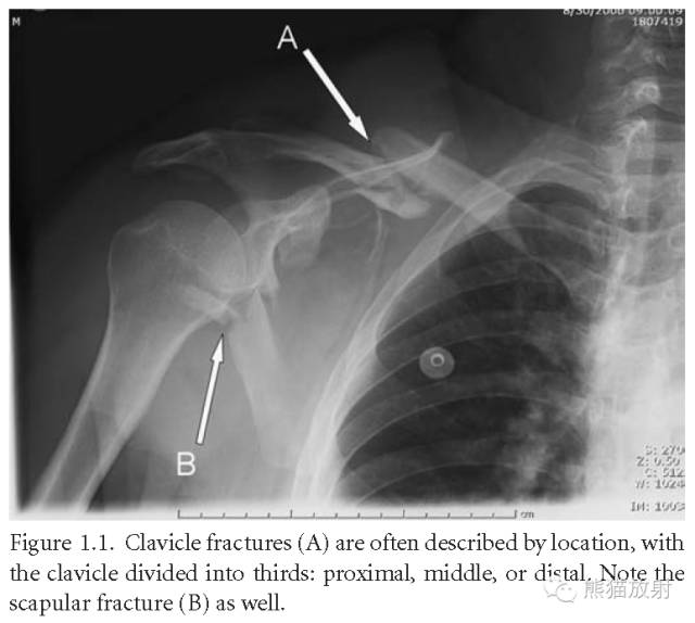 肩关节平片--临床影像示例