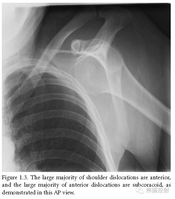 肩关节平片--临床影像示例