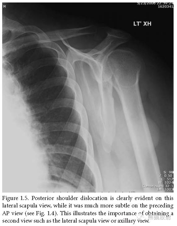 肩关节平片--临床影像示例