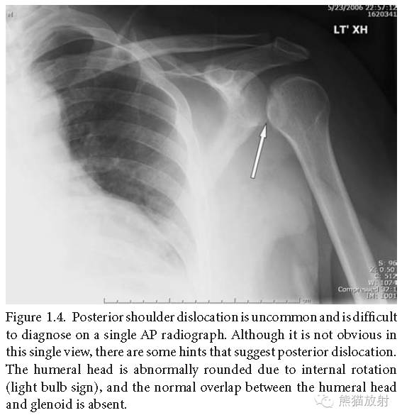 肩关节平片--临床影像示例
