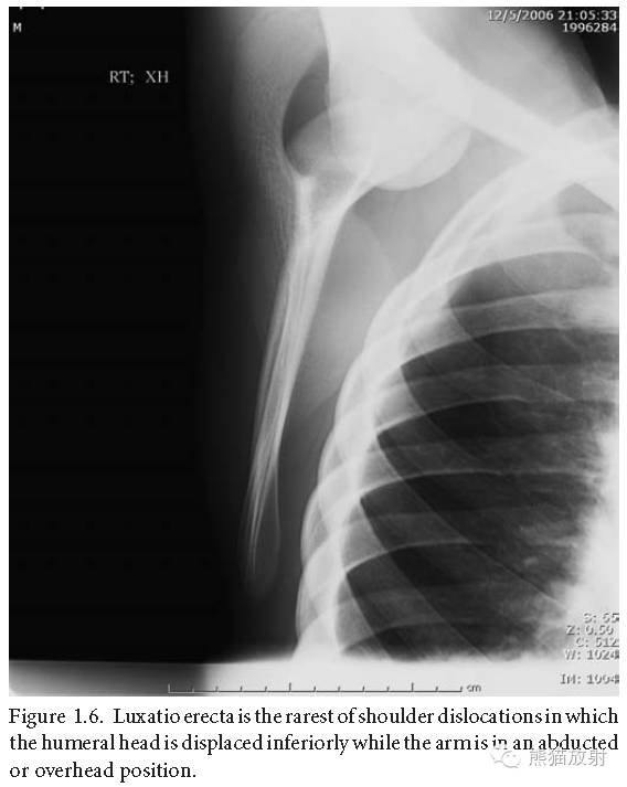 肩关节平片--临床影像示例
