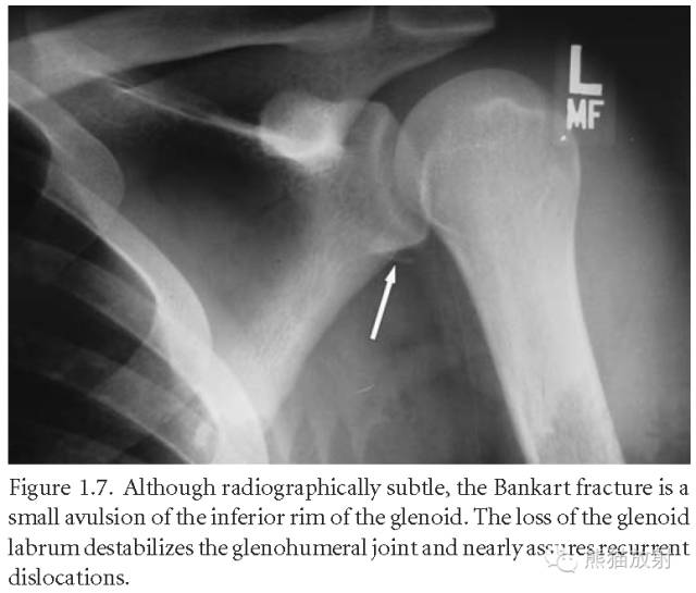 肩关节平片--临床影像示例