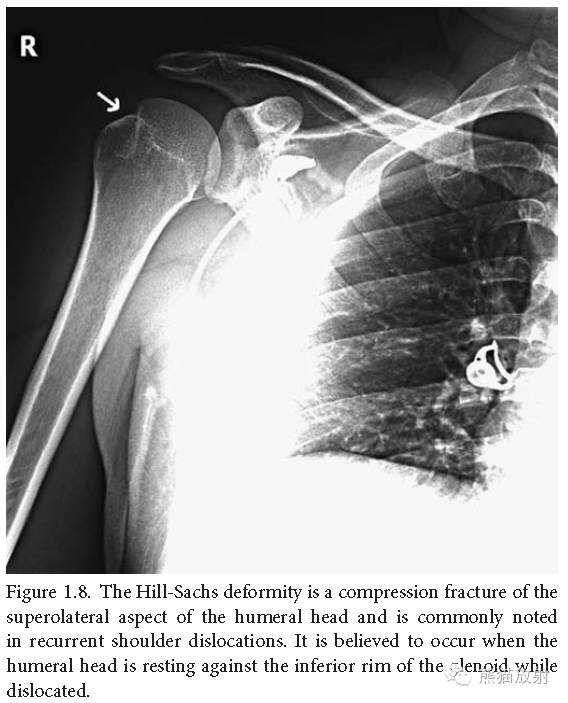 肩关节平片--临床影像示例