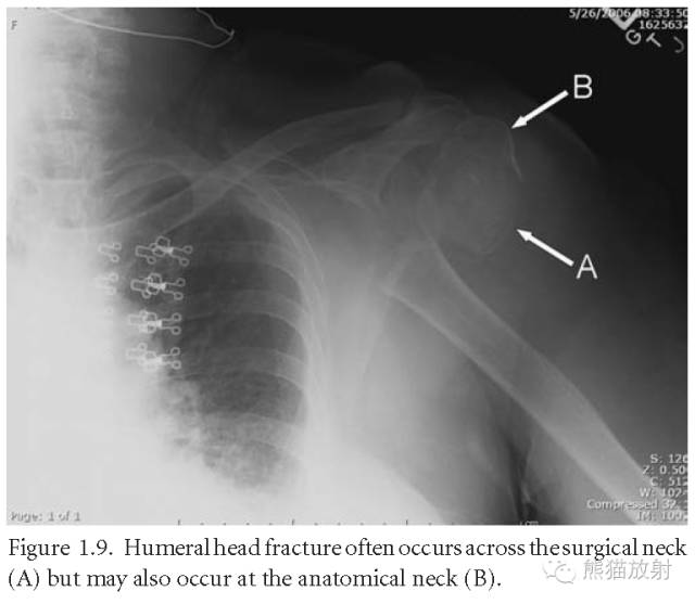 肩关节平片--临床影像示例