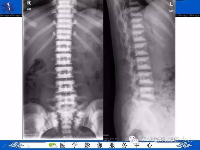 【PPT】石骨症——少见的骨病例，但是过目不忘！