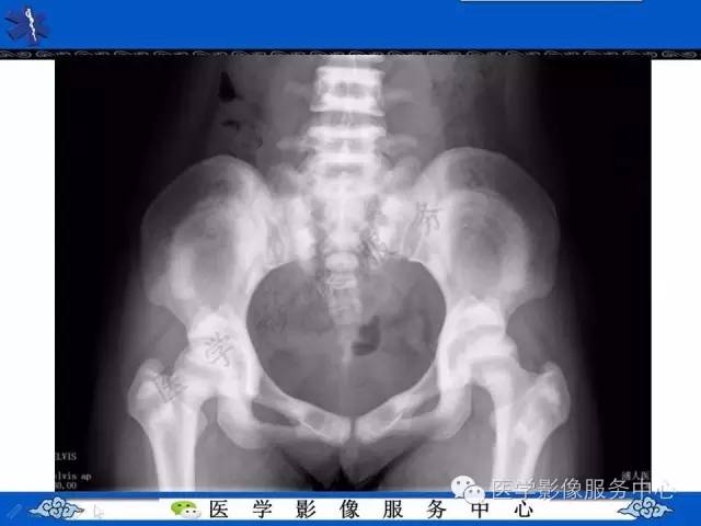 【PPT】石骨症——少见的骨病例，但是过目不忘！