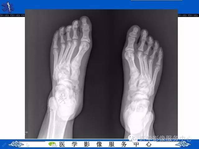 【PPT】石骨症——少见的骨病例，但是过目不忘！