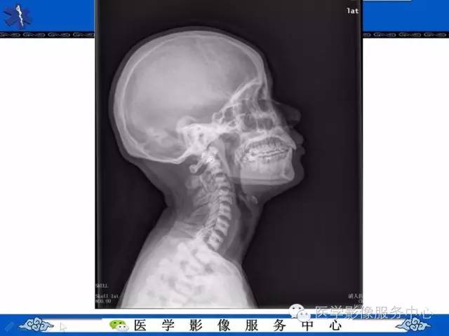 【PPT】石骨症——少见的骨病例，但是过目不忘！