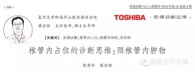 【病例】椎管内软骨瘤1例CT及MR影像表现