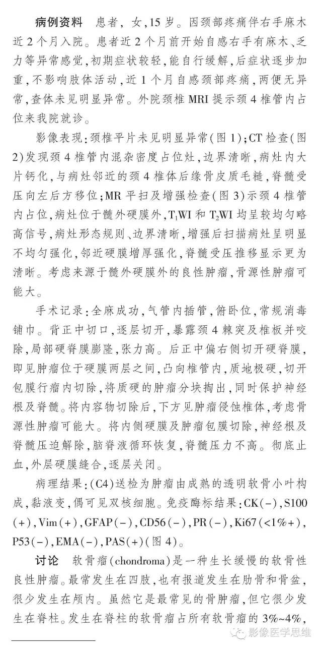 【病例】椎管内软骨瘤1例CT及MR影像表现