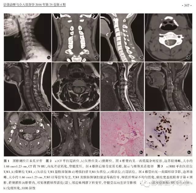 【病例】椎管内软骨瘤1例CT及MR影像表现