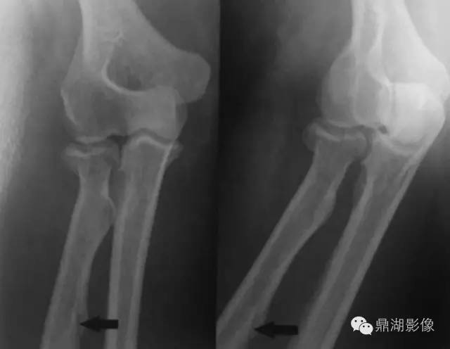 千万不要把滋养管认成“骨折”