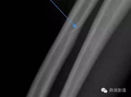 千万不要把滋养管认成“骨折”