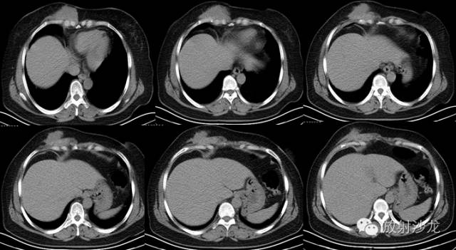 【病例】胸壁纤维瘤1例CT影像表现