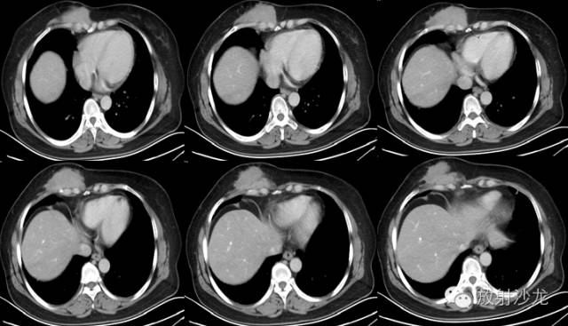 【病例】胸壁纤维瘤1例CT影像表现